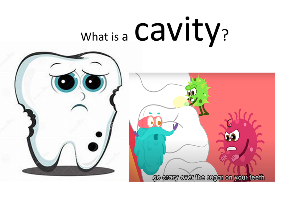 老師以生動圖片與簡單詞彙講解蛀牙cavity（圖片2）